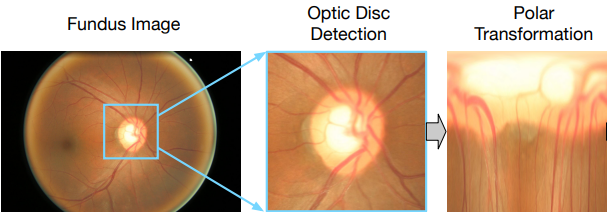 基于paddleseg的视杯视盘定位与分割