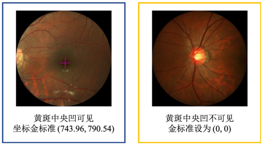 常規賽:palm眼底彩照中黃斑中央凹定位比賽baseline