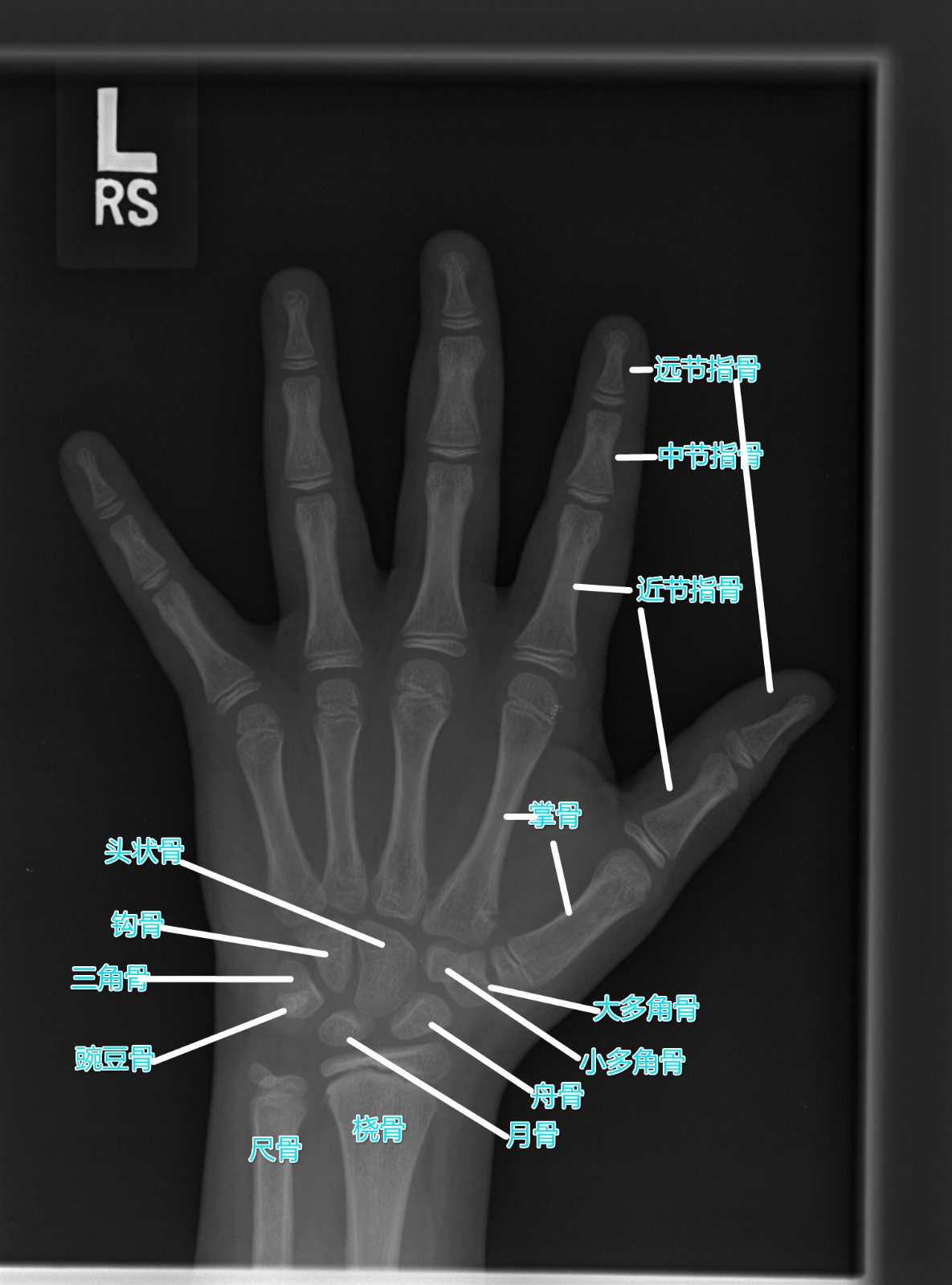 paddledetection手部x光关键点检测(快速得到成果) - 飞桨ai studio